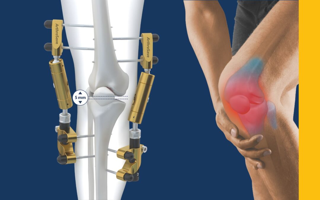 Extensive study about knee distraction